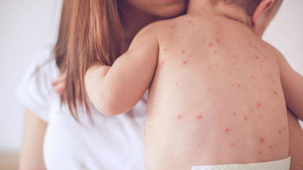 Những điều cần biết về sốt phát ban ở trẻ