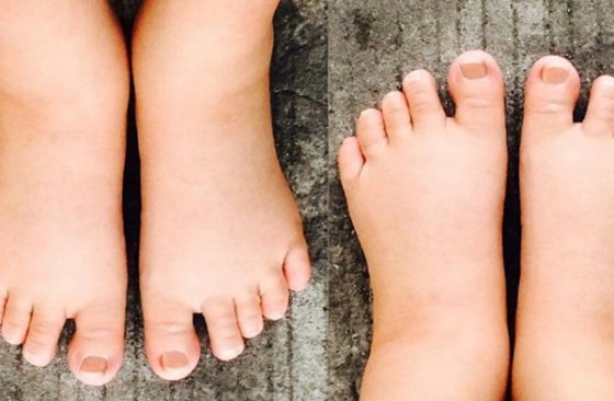 Hiện tượng phù chân khi mang thai khi nào thì gây nguy hiểm